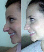 The Perfect Nose For Your Face At New Orleans Center For Aesthetics And Plastic Surgery