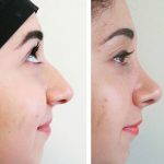 The hump on a nose can be shaved down with help of rhinoplasty