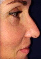Tip Nose Job In Newcastle Upon Tyne Allows The Reshaping Of The Bridge, Tip Or Profile Of Your Nose