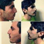 Wally Zollman's Male Rhinoplasty In Indianapolis Photos Before And After