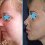 before and after nose job pictures (4)