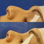 nasal bump removal before after (4)