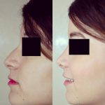 nasal hump and bulbous tip photos