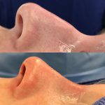 nasal hump images (1)