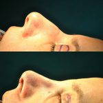 nasal hump reduction photos