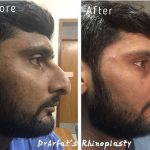nasal hump removal before after for man