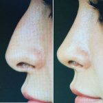 nasal hump removal before and after photo (4)