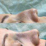 nasal hump removal before and after photo (7)