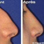 nasal hump removal preop and postop (3)