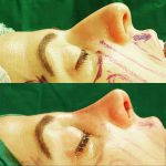 nasal hump removal preop and postop (4)