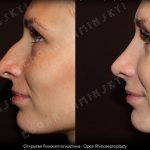 nasal hump surgery before after pictures (1)