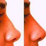 nasal hump ugly
