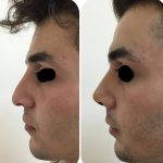 nose hump removal before and after photos (2)