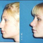 nose hump removal before and after photos (3)