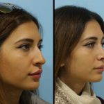 nose hump removal pictures (2)