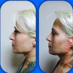 patient satisfaction is very high form nose hump removal