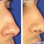 removal of nasal hump before and after (2)