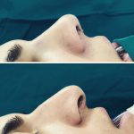 rhinoplasty nasal hump removal
