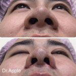 About One In Five Rhinoplasties Requires Nostril Surgery