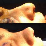 Before And After Nose Bump Correction (11)