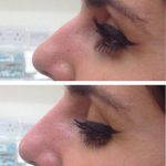 Before And After Nose Bump Correction (13)