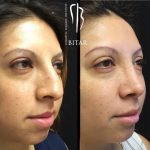 Before And After Nose Bump Correction (2)
