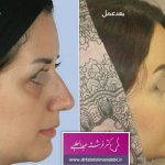 Before And After Nose Bump Correction (3)