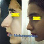 Before And After Nose Bump Correction (5)