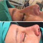 Before And After Nose Bump Surgery (4)