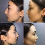 Big Nose Job Before And After Pictures (2)