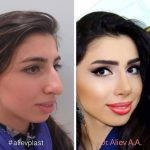 Big Nose Plastic Surgery Before And After