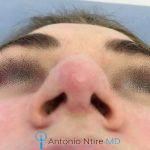 Deviated Septum Before And After Photos (2)