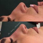 Deviated Septum Before And After Photos (3)