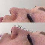 Deviated Septum Before And After Photos (4)