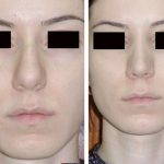 Deviated Septum Before And After Photos (6)