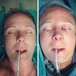 Deviated Septum Surgery Takes Anywhere From 30 To 90 Minutes To Complete, Depending On The Complexity Of The Condition