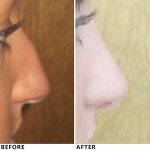 Fix Deviated Septum During Rhinoplasty Before And After (3)