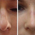 Fix Deviated Septum During Rhinoplasty Before And After (4)