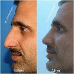 Good Male Nose Jobs (2)