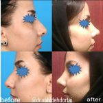 Hooked Nose Job Can Be Done As A Closed Rhinoplasty