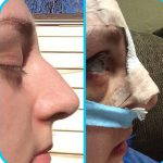 Hooked Nose Rhinoplasty Before And After Pictures (2)