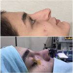 Hooked Nose Rhinoplasty Is Required To Produce A More Desirable Nasolabial Angle