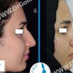 Hooked Nose Surgery Before And After Photo