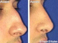 In The Proper Hands, The Rhinoplasty Is Very Safe