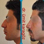 Male Nose Bump Removal (1)