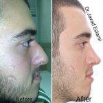 Male Nose Job Before After (3)