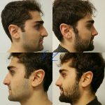 Male Nose Job Before And After Photos (10)