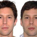 Male Nose Job Before And After Photos (3)