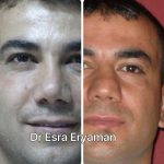 Male Nose Job Before And After Photos (4)