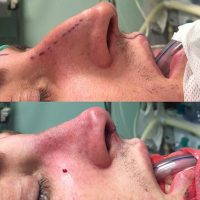 Male Nose Job If You Are Unhappy With Your Nose